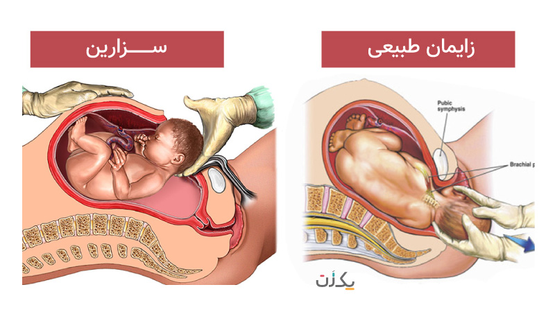 زایمان طبیعی بهتر است یا سزارین